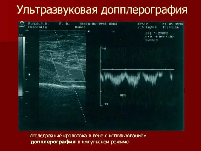 Ультразвуковая допплерография Исследование кровотока в вене с использованием допплерографии в импульсном режиме