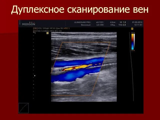 Дуплексное сканирование вен