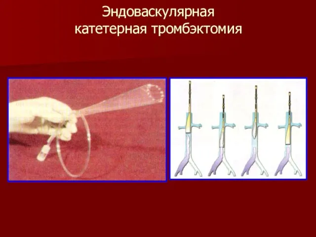 Эндоваскулярная катетерная тромбэктомия