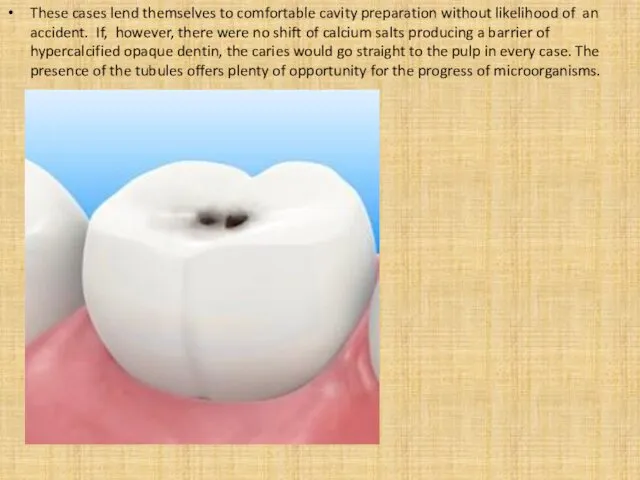 These cases lend themselves to comfortable cavity preparation without likelihood of