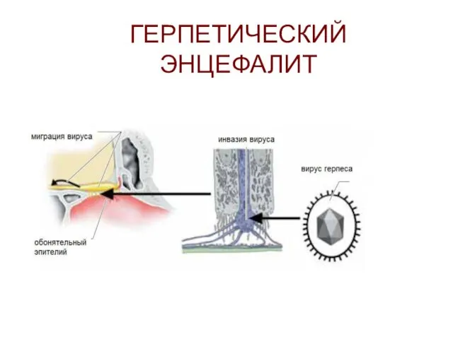 ГЕРПЕТИЧЕСКИЙ ЭНЦЕФАЛИТ