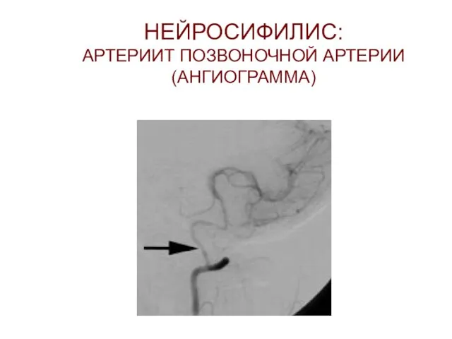 НЕЙРОСИФИЛИС: АРТЕРИИТ ПОЗВОНОЧНОЙ АРТЕРИИ (АНГИОГРАММА)