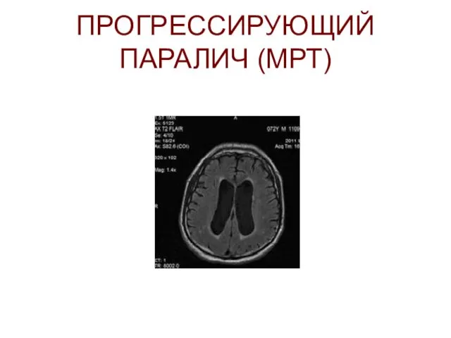 ПРОГРЕССИРУЮЩИЙ ПАРАЛИЧ (МРТ)