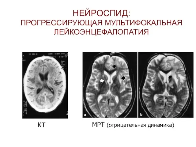 НЕЙРОСПИД: ПРОГРЕССИРУЮЩАЯ МУЛЬТИФОКАЛЬНАЯ ЛЕЙКОЭНЦЕФАЛОПАТИЯ КТ МРТ (отрицательная динамика)