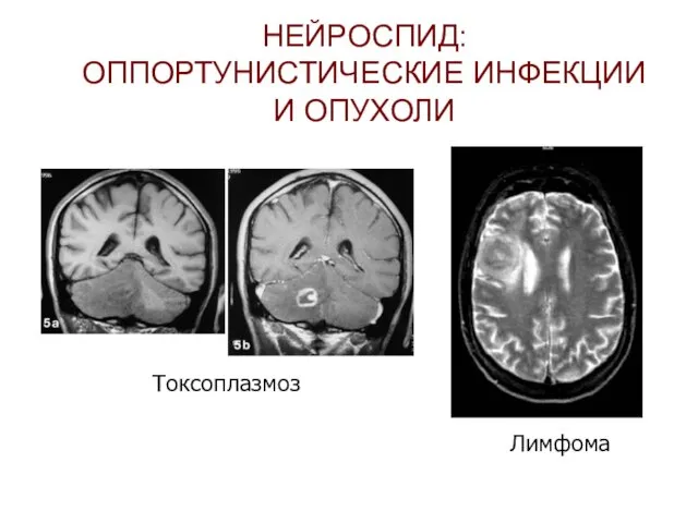 НЕЙРОСПИД: ОППОРТУНИСТИЧЕСКИЕ ИНФЕКЦИИ И ОПУХОЛИ Токсоплазмоз Лимфома