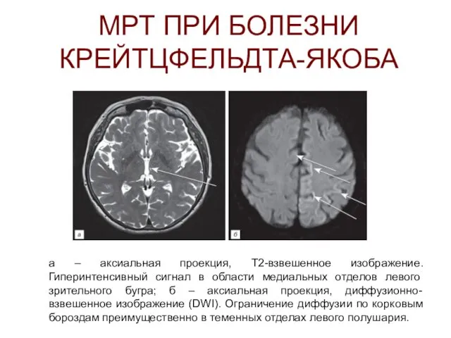 МРТ ПРИ БОЛЕЗНИ КРЕЙТЦФЕЛЬДТА-ЯКОБА а – аксиальная проекция, Т2-взвешенное изображение. Гиперинтенсивный