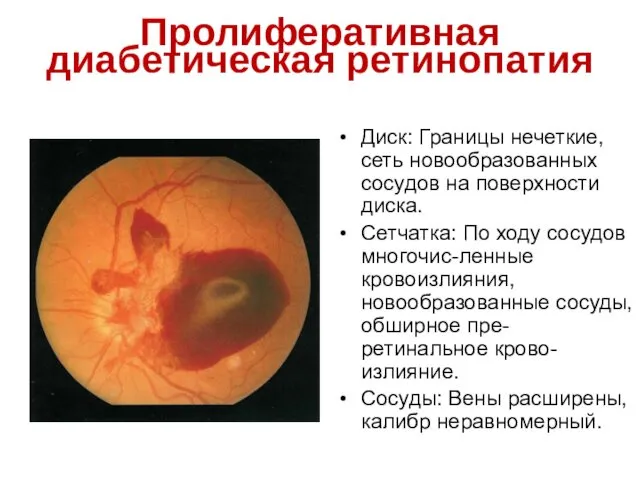 Пролиферативная диабетическая ретинопатия Диск: Границы нечеткие, сеть новообразованных сосудов на поверхности