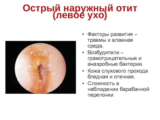 Острый наружный отит (левое ухо) Факторы развития – травмы и влажная