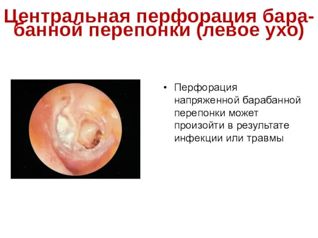 Центральная перфорация бара-банной перепонки (левое ухо) Перфорация напряженной барабанной перепонки может