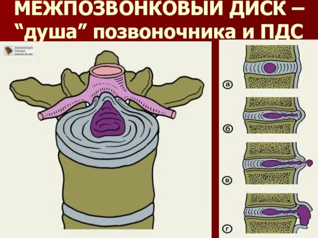 МЕЖПОЗВОНКОВЫЙ ДИСК – “душа” позвоночника и ПДС