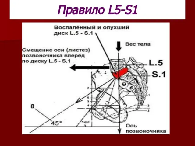 Правило L5-S1