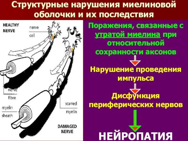 Структурные нарушения миелиновой оболочки и их последствия Поражения, связанные с утратой