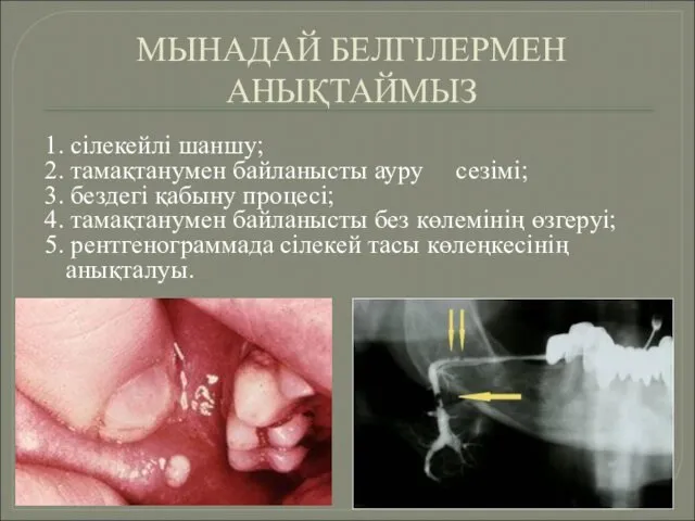 МЫНАДАЙ БЕЛГІЛЕРМЕН АНЫҚТАЙМЫЗ 1. сілекейлі шаншу; 2. тамақтанумен байланысты ауру сезімі;