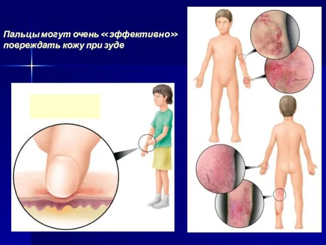 Пальцы могут очень «эффективно» повреждать кожу при зуде