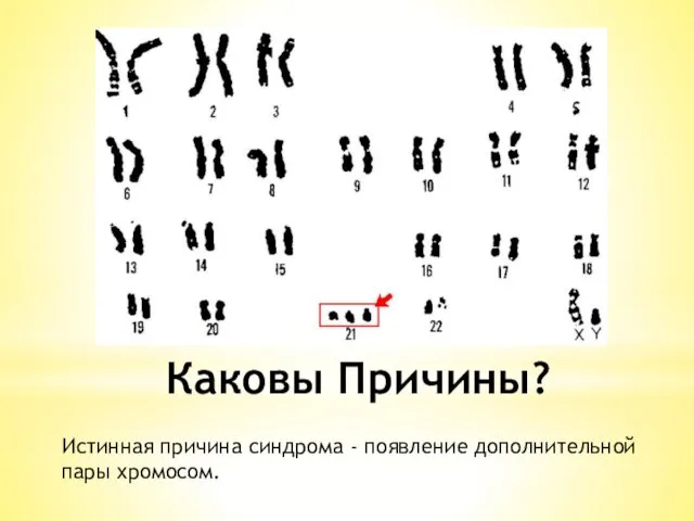 Каковы Причины? Истинная причина синдрома - появление дополнительной пары хромосом.