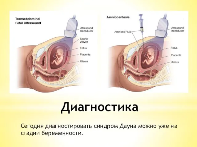 Диагностика Сегодня диагностировать синдром Дауна можно уже на стадии беременности.