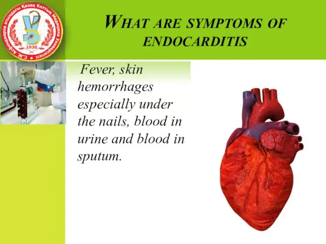 What are symptoms of endocarditis Fever, skin hemorrhages especially under the