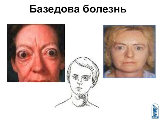 Базедова болезнь