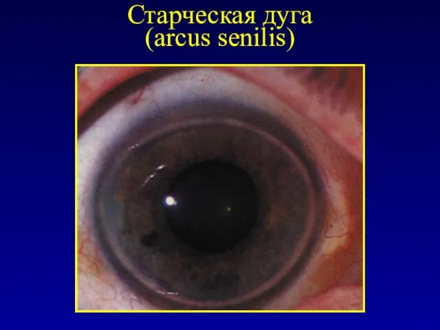 Старческая дуга (arcus senilis)