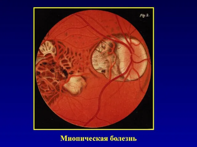 Миопическая болезнь