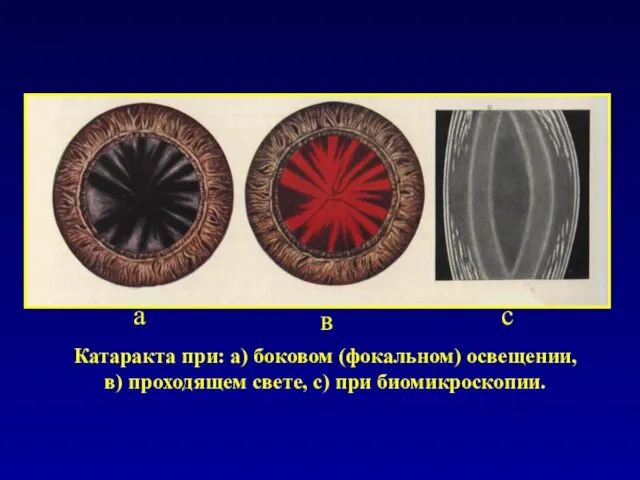 Катаракта при: а) боковом (фокальном) освещении, в) проходящем свете, c) при биомикроскопии. а в с