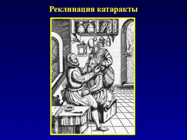 Реклинация катаракты