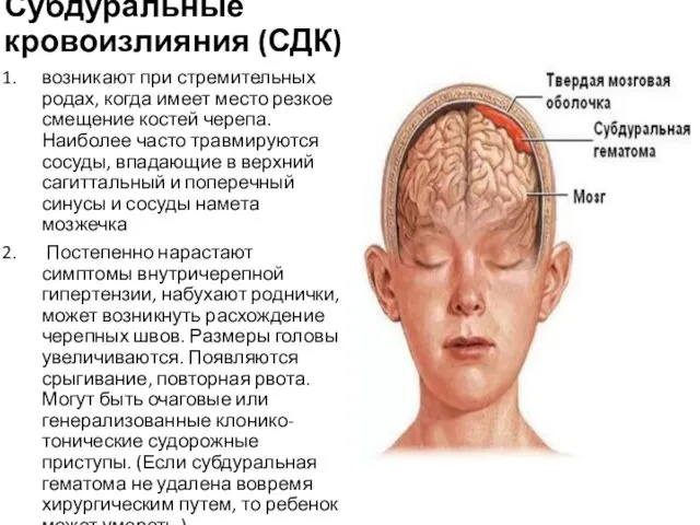 Субдуральные кровоизлияния (СДК) возникают при стремительных родах, когда имеет место резкое