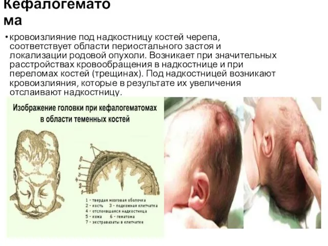 Кефалогематома кровоизлияние под надкостницу костей черепа, соответствует области периостального застоя и