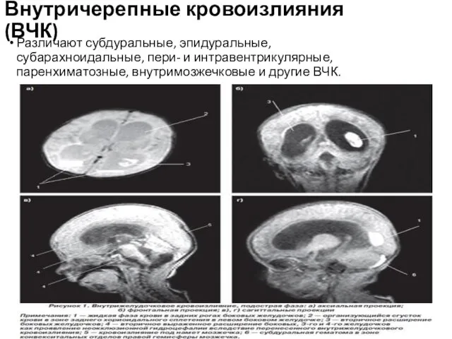 Внутричерепные кровоизлияния (ВЧК) Различают субдуральные, эпидуральные, субарахноидальные, пери- и интравентрикулярные, паренхиматозные, внутримозжечковые и другие ВЧК.