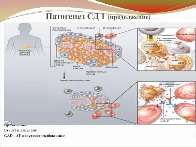 Патогенез СД 1 (продолжение) Примечание: IA - АТ к инсулину, GAD - АТ к глутаматдекабоксилазе