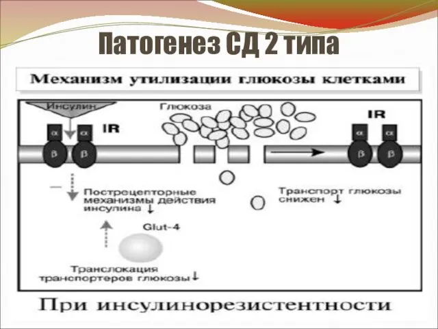 Патогенез СД 2 типа