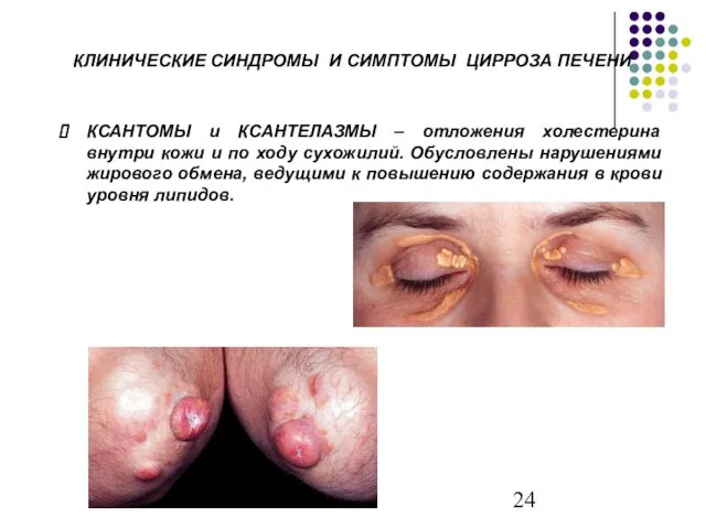 КСАНТОМЫ и КСАНТЕЛАЗМЫ – отложения холестерина внутри кожи и по ходу