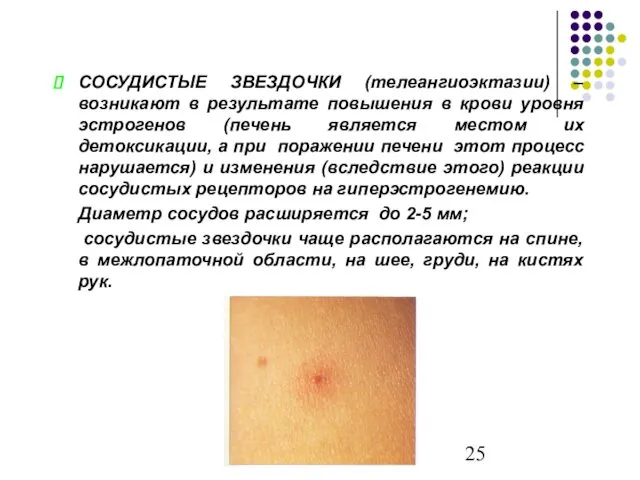 СОСУДИСТЫЕ ЗВЕЗДОЧКИ (телеангиоэктазии) – возникают в результате повышения в крови уровня