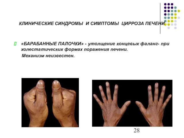 «БАРАБАННЫЕ ПАЛОЧКИ» - утолщение концевых фаланг- при холестатических формах поражения печени.