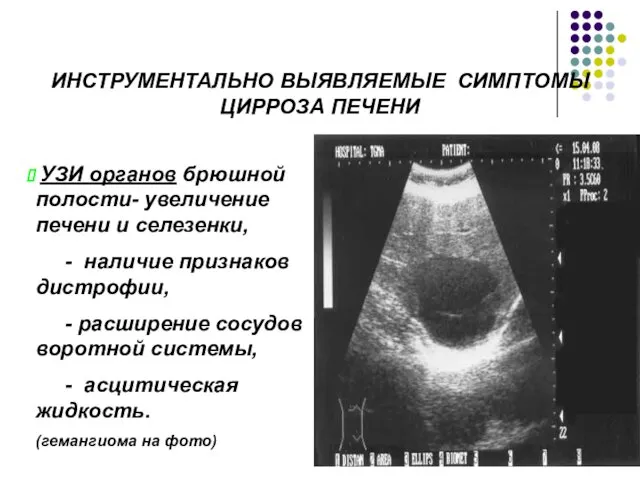 ИНСТРУМЕНТАЛЬНО ВЫЯВЛЯЕМЫЕ СИМПТОМЫ ЦИРРОЗА ПЕЧЕНИ УЗИ органов брюшной полости- увеличение печени