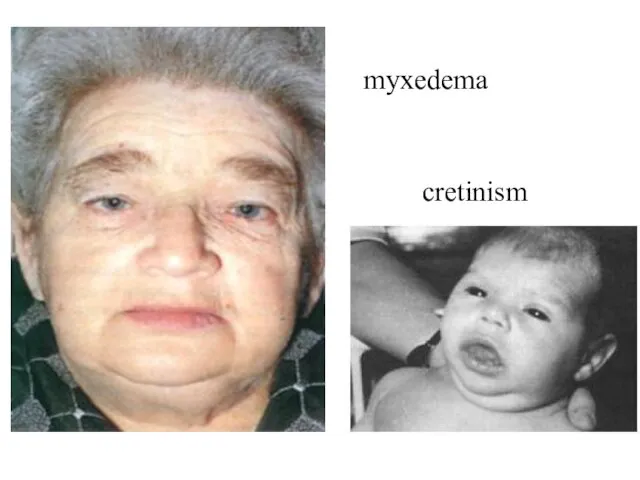 myxedema cretinism