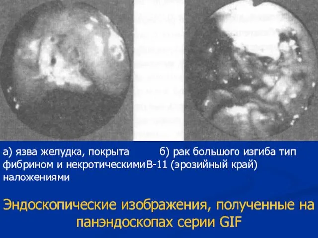 а) язва желудка, покрыта б) рак большого изгиба тип фибрином и