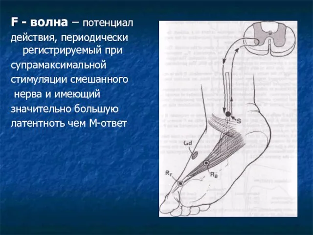 F - волна – потенциал действия, периодически регистрируемый при супрамаксимальной стимуляции