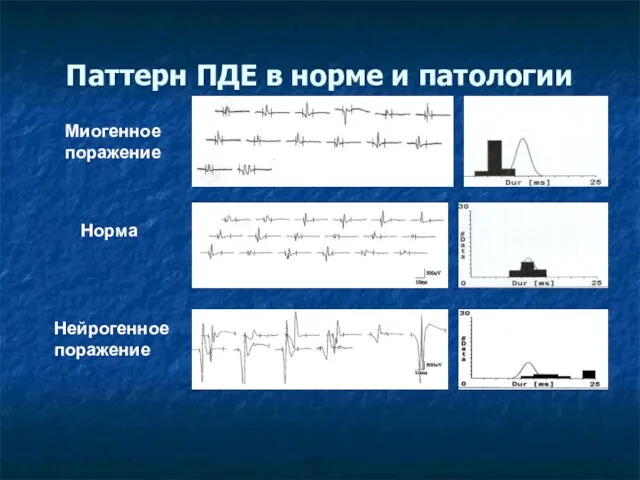 Паттерн ПДЕ в норме и патологии Миогенное поражение Норма Нейрогенное поражение