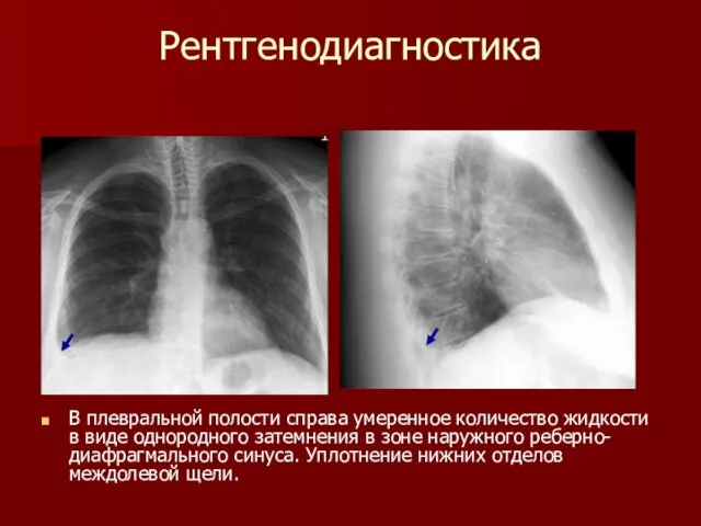 Рентгенодиагностика В плевральной полости справа умеренное количество жидкости в виде однородного