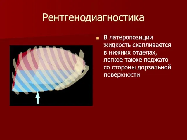 Рентгенодиагностика В латеропозиции жидкость скапливается в нижних отделах, легкое также поджато со стороны дорзальной поверхности