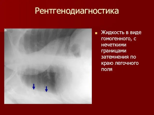 Рентгенодиагностика Жидкость в виде гомогенного, с нечеткими границами затемнения по краю легочного поля
