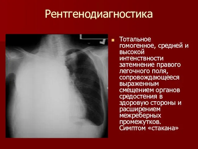 Рентгенодиагностика Тотальное гомогенное, средней и высокой интенствности затемнение правого легочного поля,