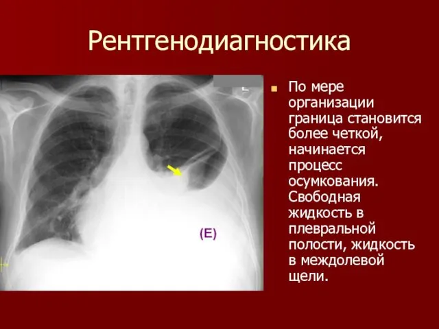 Рентгенодиагностика По мере организации граница становится более четкой, начинается процесс осумкования.