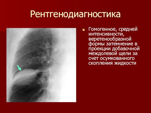 Рентгенодиагностика Гомогенное, средней интенсивности, веретенообразной формы затемнение в проекции добавочной междолевой