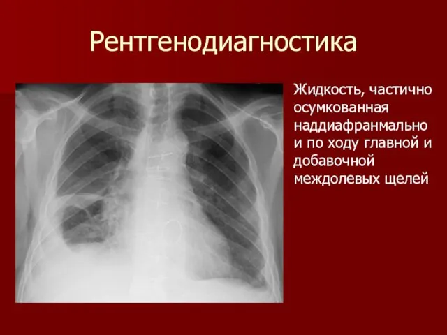 Рентгенодиагностика Жидкость, частично осумкованная наддиафранмально и по ходу главной и добавочной междолевых щелей