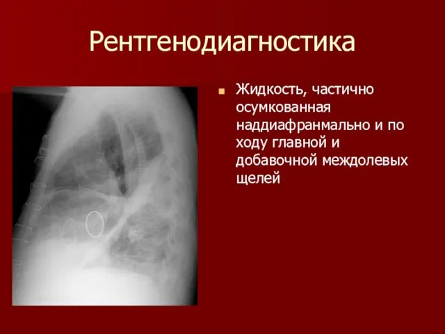 Рентгенодиагностика Жидкость, частично осумкованная наддиафранмально и по ходу главной и добавочной междолевых щелей