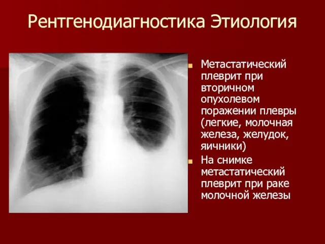 Рентгенодиагностика Этиология Метастатический плеврит при вторичном опухолевом поражении плевры (легкие, молочная