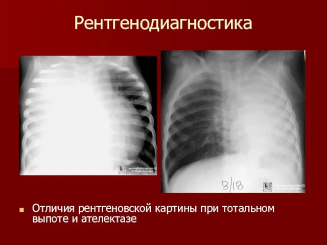 Рентгенодиагностика Отличия рентгеновской картины при тотальном выпоте и ателектазе