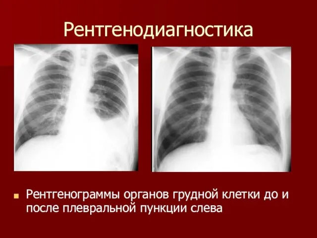Рентгенодиагностика Рентгенограммы органов грудной клетки до и после плевральной пункции слева